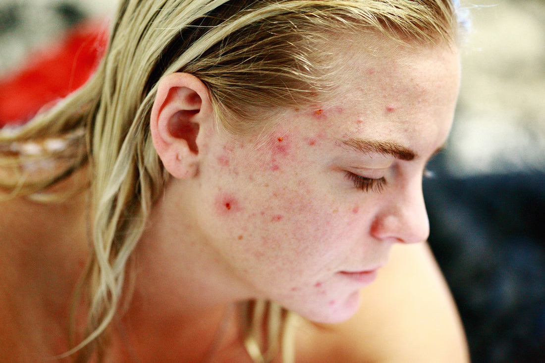 Why Do You Have Sensitive Skin?